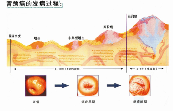 子宫颈疾病3.jpg