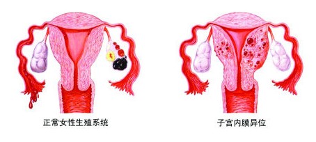 子宫内膜异位症.jpg